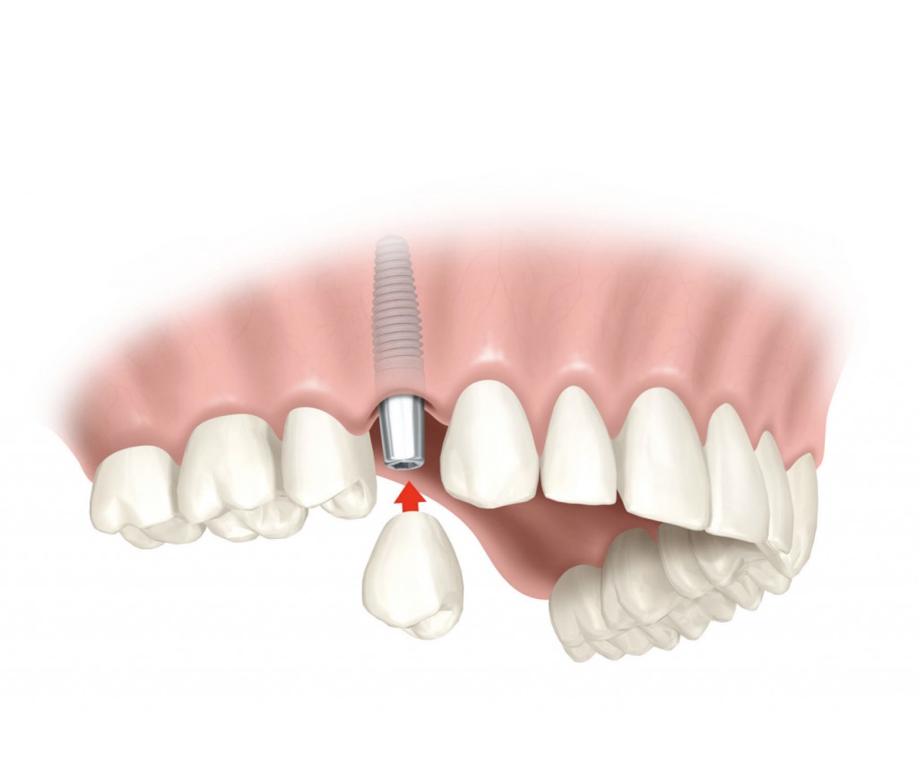 Implantología dental Aranjuez